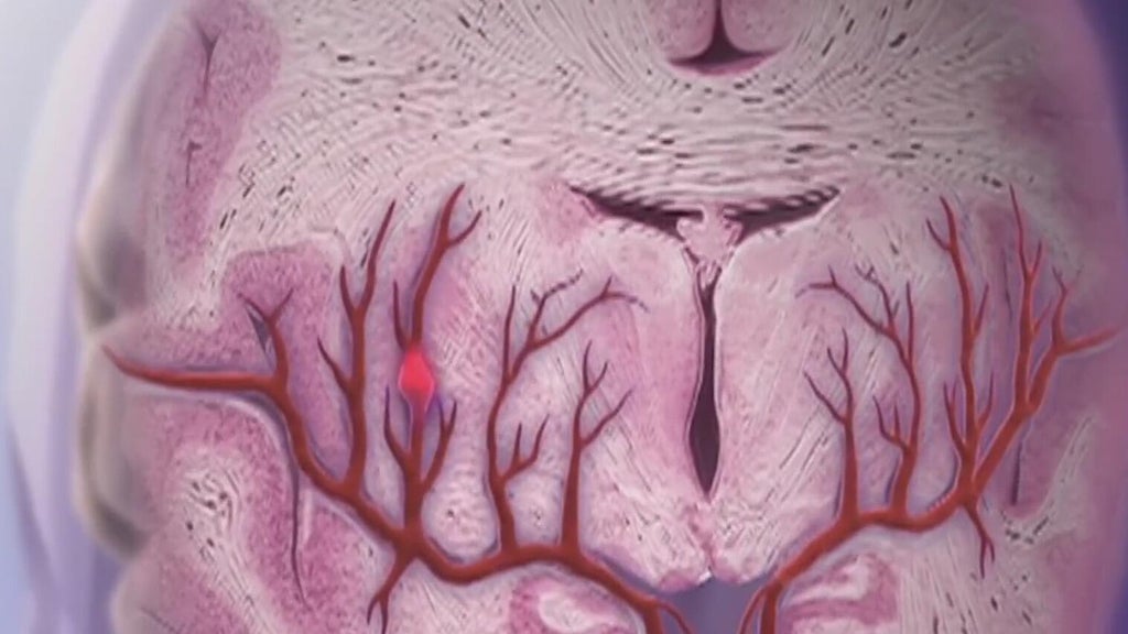 Knowing the signs of a stroke can save lives — Statesboro Community news